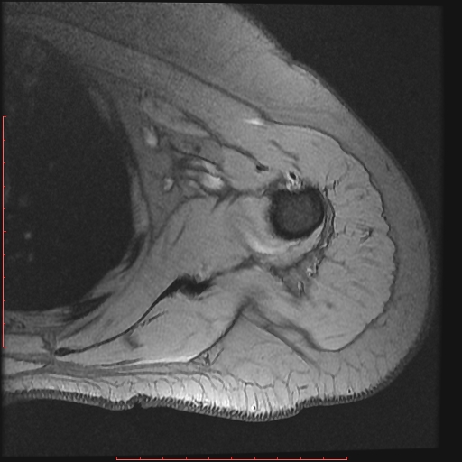 File:Avulsion fracture - greater tuberosity of humerus (Radiopaedia 25457-25703 Axial Gradient Echo 15).jpg