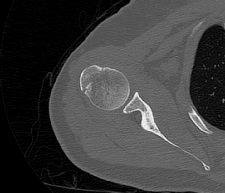 Avulsion fracture - greater tuberosity of humerus (Radiopaedia 71216-81514 Axial bone window 35).jpg