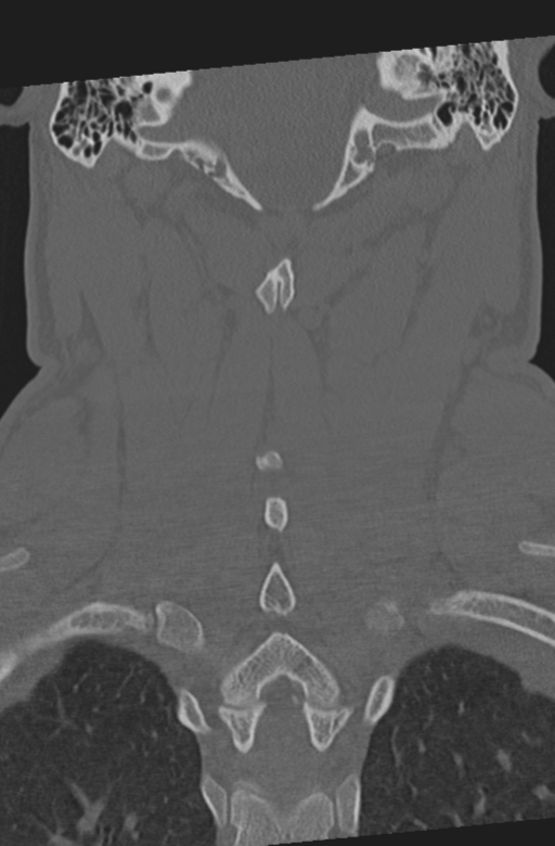 Axis peg fracture (type 3) and atlas lateral mass (type 4) fracture (Radiopaedia 37474-39324 Coronal bone window 42).png