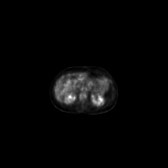 B-cell lymphoma of the mesentery (Radiopaedia 65743-74868 18F-FDG PET-CT 152).jpg
