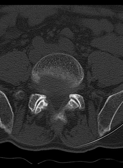 File:Baastrup syndrome (Radiopaedia 64891-73838 Axial bone window 12).jpg