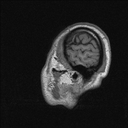 Balo concentric sclerosis (Radiopaedia 50458-55940 Sagittal T1 140).jpg