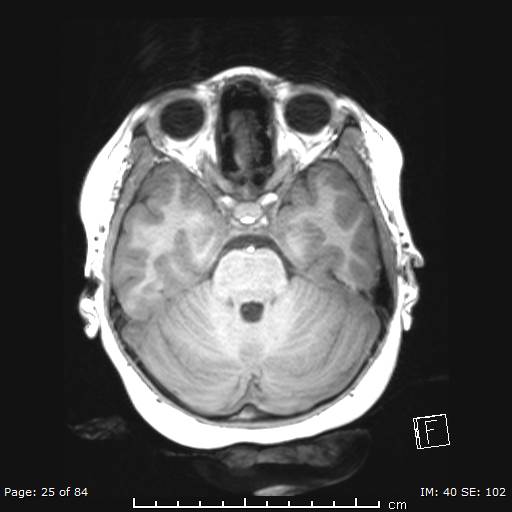 Balo concentric sclerosis (Radiopaedia 61637-69636 Axial T1 25).jpg