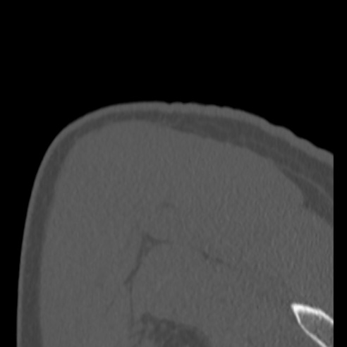 Bankart lesion (Radiopaedia 57256-64185 Coronal bone window 44).jpg