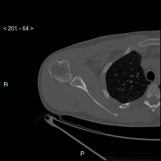 Bankart lesion with glenoid bone defect - assessment TC with PICO method (Radiopaedia 42855-93901 Axial bone window 63).jpg