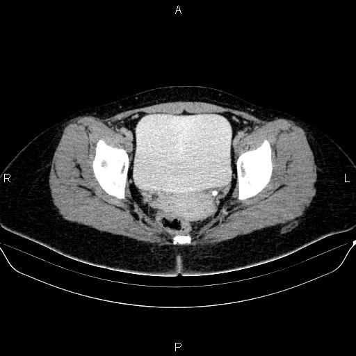 Bartholin gland cyst (Radiopaedia 62635-70930 C 58).jpg