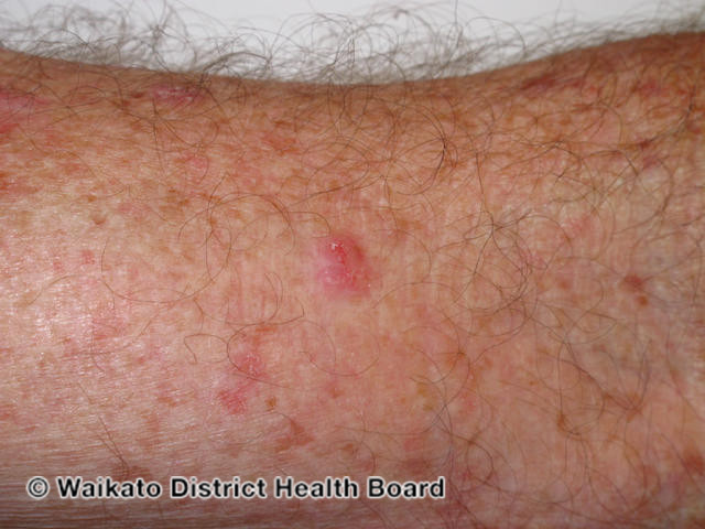 File:Basal cell carcinoma, arm (DermNet NZ bcc-arm-28-wdhb).jpg