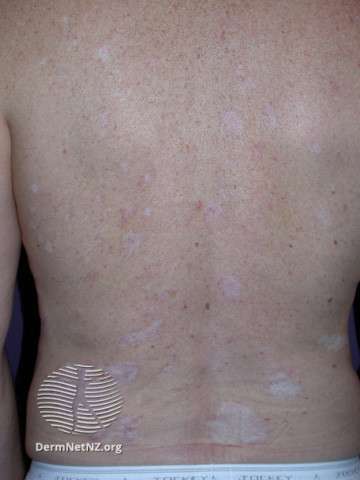 File:Basal cell carcinoma affecting the trunk (DermNet NZ lesions-bcc-trunk-1014).jpg