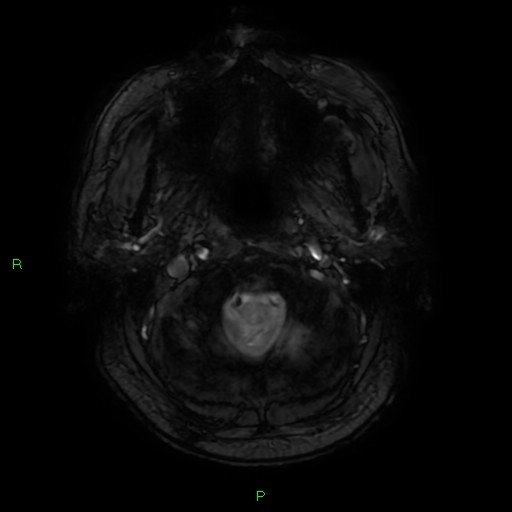 Basal ganglia hemorrhage (Radiopaedia 58346-65468 Axial SWI 2).jpg