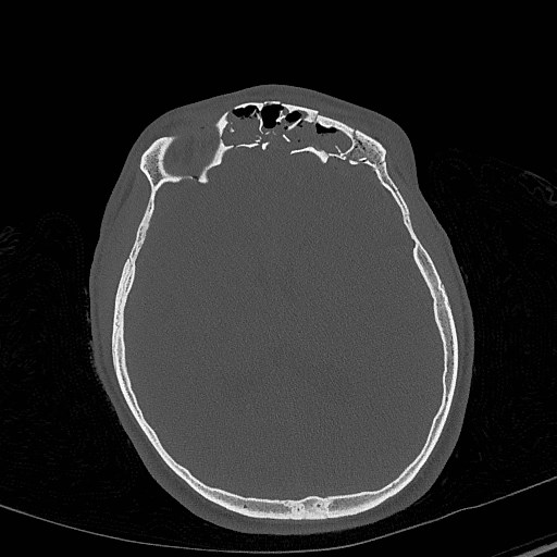 Base of skull fracture with bilateral Le Fort fractures (Radiopaedia 47094-51638 Axial bone window 52).jpg