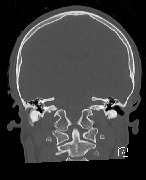 Base of skull fracture with bilateral Le Fort fractures (Radiopaedia 47094-51638 Coronal bone window 42).jpg