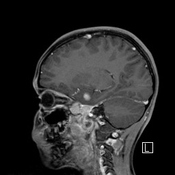 Base of skull rhabdomyosarcoma (Radiopaedia 32196-33142 J 25).jpg
