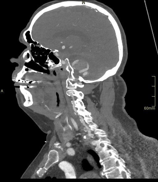 Basilar artery aneurysm (Radiopaedia 56261-62932 C 20).jpg