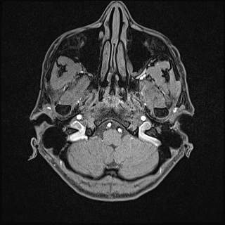 Basilar artery perforator aneurysm (Radiopaedia 82455-97733 Axial T1 fat sat 15).jpg