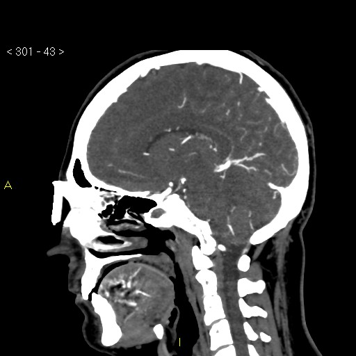Basilar artery thrombosis (Radiopaedia 16260-15944 C 37).jpg