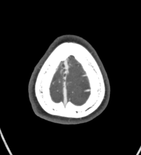 Basilar tip aneurysm with coiling (Radiopaedia 53912-60086 A 141).jpg