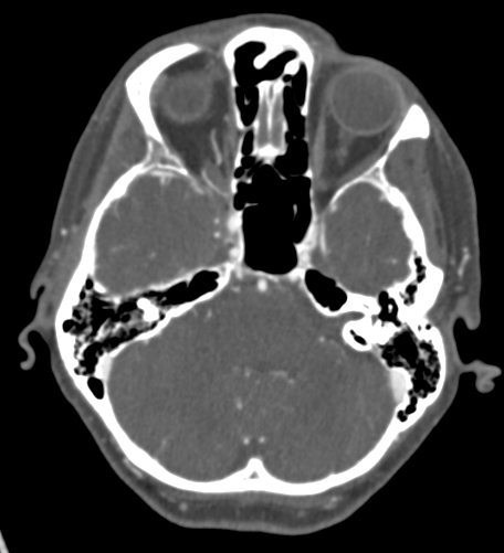 Basilar tip aneurysm with coiling (Radiopaedia 53912-60086 A 42).jpg