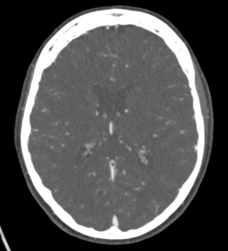 Basilar tip aneurysm with coiling (Radiopaedia 53912-60086 A 87).jpg