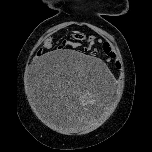 Benign leiomyoma with hydropic features (Radiopaedia 89250-106130 B 33).jpg