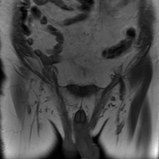 File:Benign prostatic nodular hyperplasia (Radiopaedia 16917-16634 Coronal T1 2).jpg