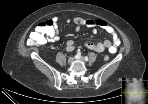Bicameral celiacomesenteric aneurysm (Radiopaedia 55766-62327 A 44).jpg