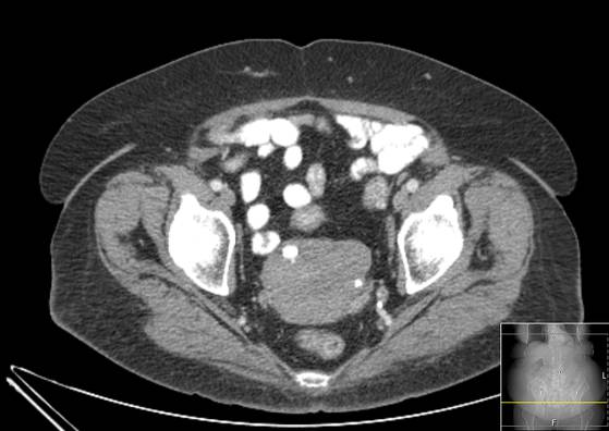 Bicameral celiacomesenteric aneurysm (Radiopaedia 55766-62327 A 63).jpg