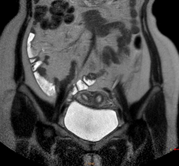 File:Bicornuate uterus with left renal agenesis (Radiopaedia 19829-19879 Coronal T2 1).JPG