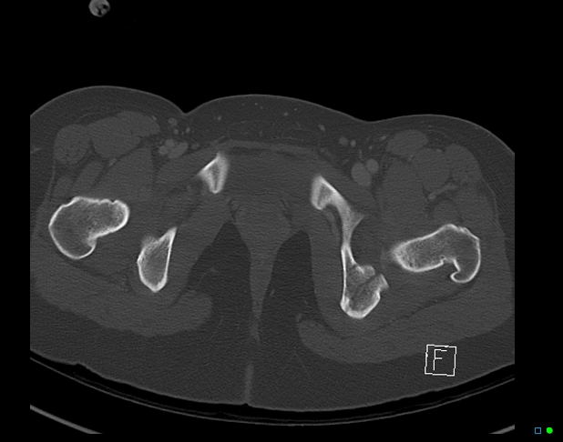 File:Bilateral acetabular fractures (Radiopaedia 79272-92308 Axial bone window 54).jpg