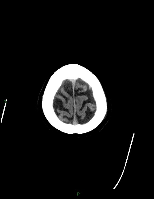 Bilateral acute middle cerebral artery territory infarcts (Radiopaedia 77319-89401 Axial non-contrast 85).jpg