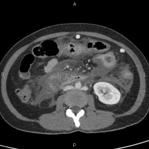 Bilateral adrenal gland hyperenhancement in pancreatitis (Radiopaedia 86642-102753 E 59).jpg