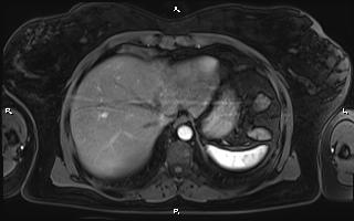 Bilateral adrenal myelolipoma (Radiopaedia 63058-71537 Axial T1 C+ fat sat 16).jpg