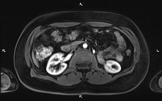 Bilateral adrenal myelolipoma (Radiopaedia 63058-71537 Axial T1 C+ fat sat 52).jpg