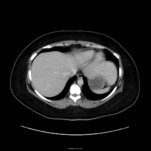 Bilateral adrenal thrombosis (Radiopaedia 58182-65256 A 6).jpg