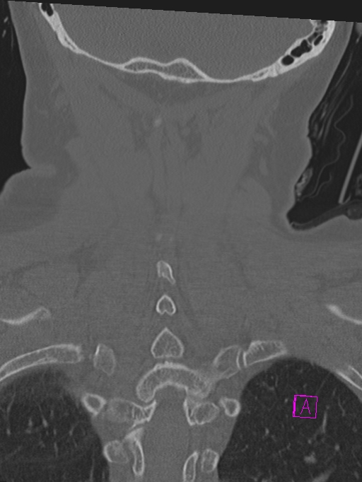 Bilateral atlanto-occipital assimilation (Radiopaedia 28350-28603 Coronal bone window 40).jpg