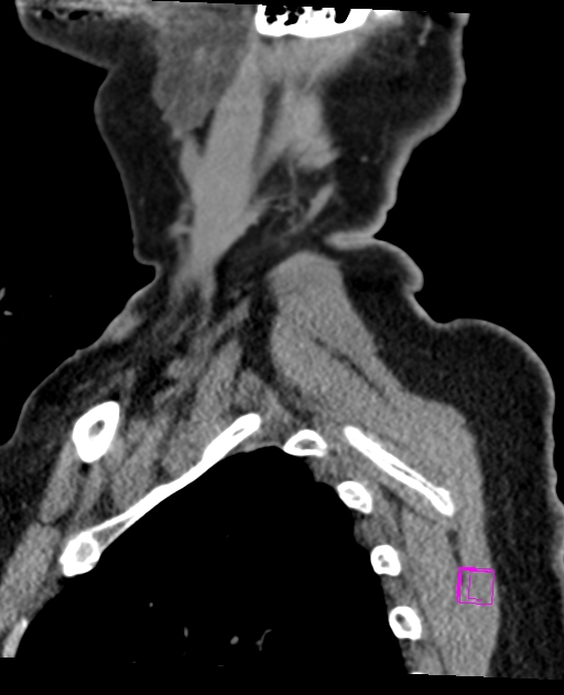 Bilateral atlanto-occipital assimilation (Radiopaedia 28350-28603 D 74).jpg
