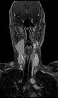 File:Bilateral carotid body tumors and right glomus jugulare tumor (Radiopaedia 20024-20060 MRA 21).jpg