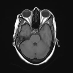 File:Bilateral carotid body tumors and right jugular paraganglioma (Radiopaedia 20024-20060 Axial 29).jpg