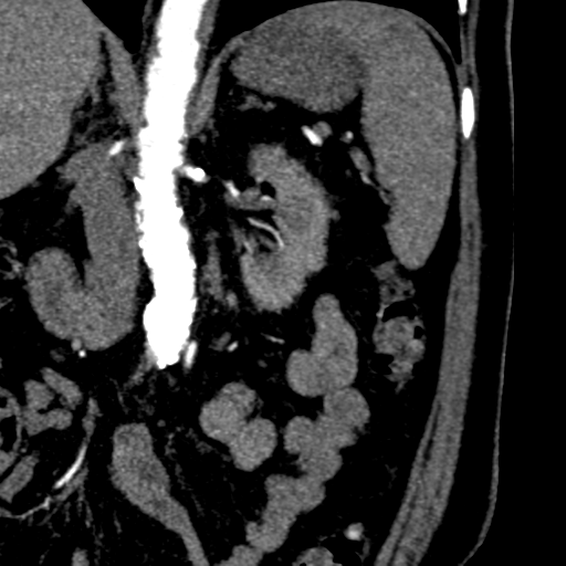 File:Bilateral delayed nephrogram from renal artery stenosis (Radiopaedia 47681-52362 B 9).png