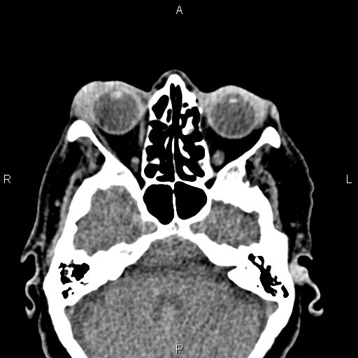 Bilateral enlargement of lacrimal glands - sarcoidosis (Radiopaedia 62627-70921 Axial non-contrast 38).jpg
