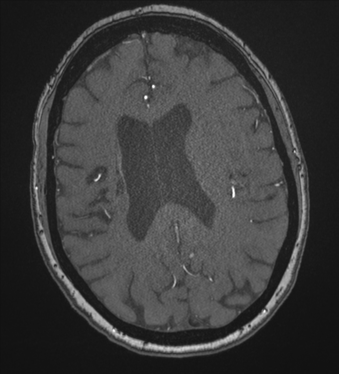 Bilateral fetal posterior communicating arteries (Radiopaedia 41286-44102 Axial MRA 141).png
