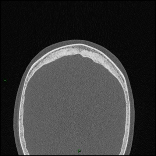 Bilateral frontal mucoceles (Radiopaedia 82352-96454 Axial bone window 28).jpg