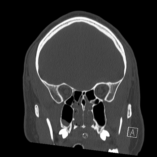 Bilateral occipital condyle fracture (type 2) (Radiopaedia 87675-104089 Coronal bone window 28).jpg