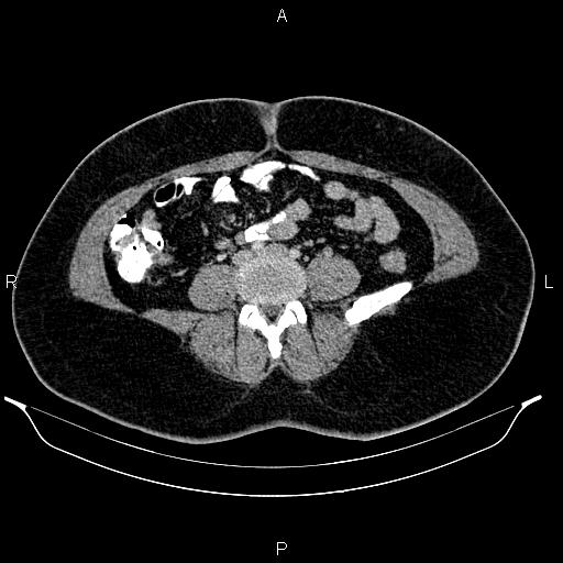Bilateral ovarian dermoid cysts (Radiopaedia 85785-101603 A 68).jpg