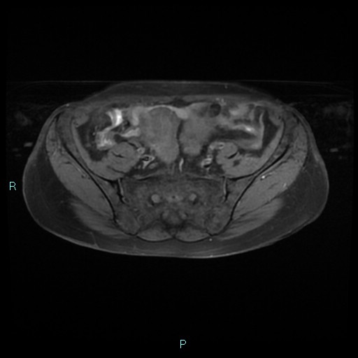 File:Bilateral ovarian fibroma (Radiopaedia 44568-48293 Axial T1 fat sat 6).jpg