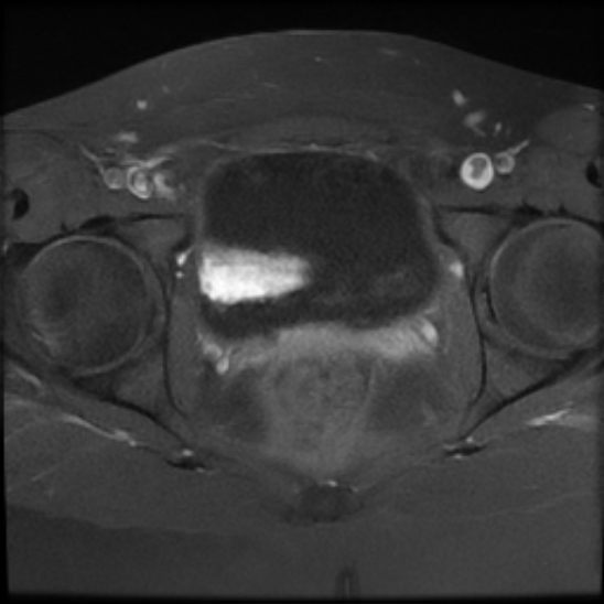 File:Bilateral ovarian fibrothecomas - adolescent (Radiopaedia 86604-102707 Axial T1 C+ fat sat 23).jpg