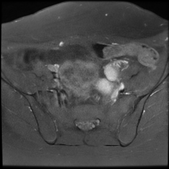 File:Bilateral ovarian fibrothecomas - adolescent (Radiopaedia 86604-102707 Axial T1 C+ fat sat 9).jpg