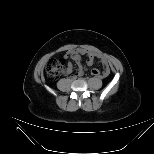 File:Bilateral ovarian mature cystic teratomas (Radiopaedia 79373-92457 Axial non-contrast 33).jpg