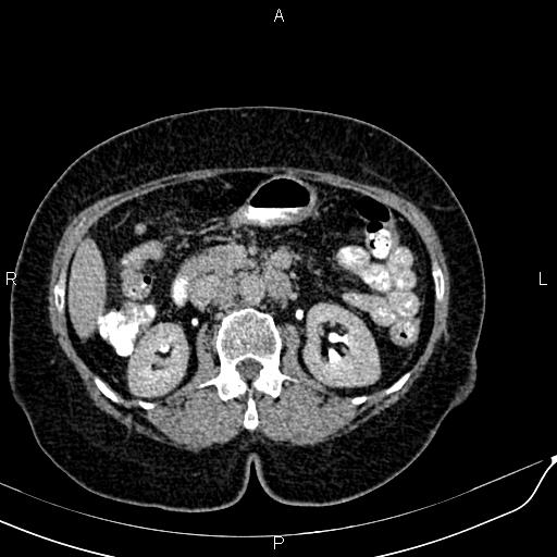 Bilateral ovarian serous cystadenocarcinoma (Radiopaedia 86062-101989 Axial C+ delayed 24).jpg