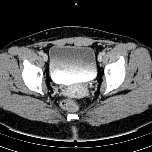 Bilateral ovarian teratoma (Radiopaedia 83131-97503 B 58).jpg