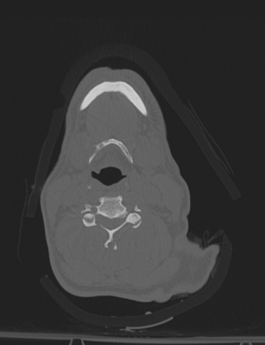 Bilateral perched facet joint (Radiopaedia 63149-71669 Axial bone window 29).jpg